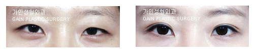 절개법/앞트임/눈매교정