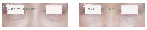 하안검[눈밑지방재배치]