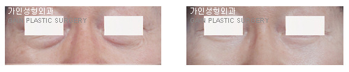 하안검[눈밑지방재배치]