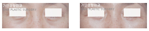 하안검[눈밑지방재배치]