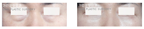 하안검[눈밑지방재배치]