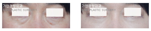 하안검[눈밑지방재배치]