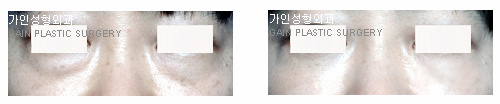 하안검[눈밑지방재배치]