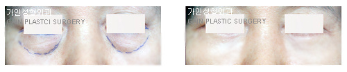 하안검[눈밑지방재배치]