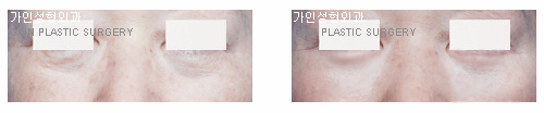 하안검[눈밑지방재배치]