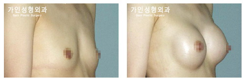 가슴확대
