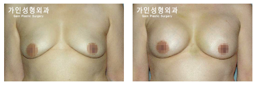 가슴확대