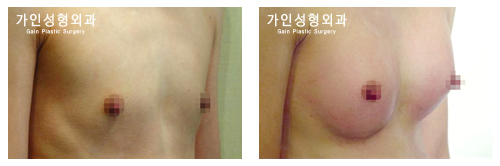 가슴 확대