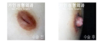 함몰 유두