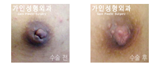 함몰 유두