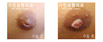 함몰 유두