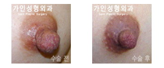 유두 축소
