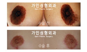 유룬 축소