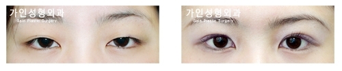 절개법