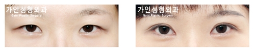 절개법 / 눈매교정 [아웃라인]
