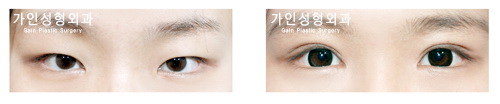 절개법 / 눈매교정 / 앞트임