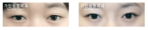 부분절개