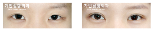 절개법재수술