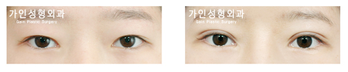 절개법재수술