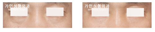 하안검