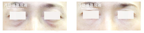 하안검
