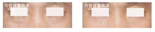 하안검