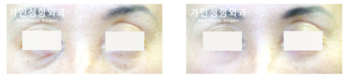 하안검