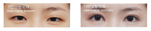 눈매교정 / 앞트임
