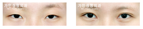 절개법 / 눈매교정 / 앞트임