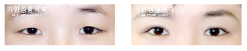 절개법 / 눈매교정 / 앞트임