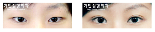 절개법 / 눈매교정 / 앞트임