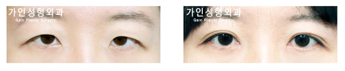 절개법 / 눈매교정/ 앞트임