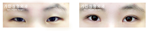 절개법 / 눈매교정 / 앞트임