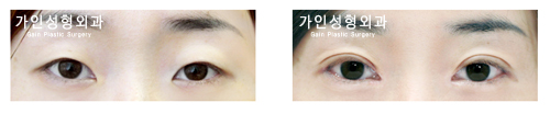 절개법 / 앞트임