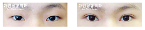 절개법 /눈매교정/ 앞트임