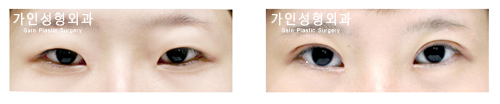 절개법 /  앞트임