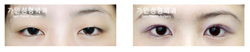 절개법 / 눈매교정