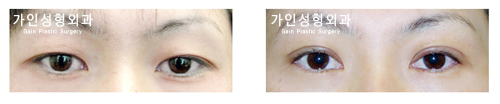 절개법 / 상안검
