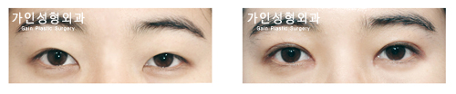 절개법 / 눈매교정