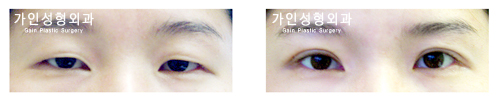 절개법 / 안검하수