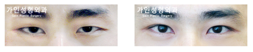 절개법