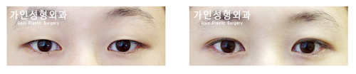 절개법