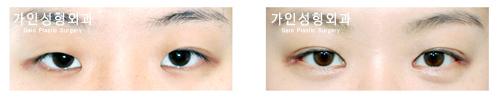 앞트임