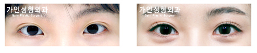 앞트임