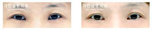 앞트임