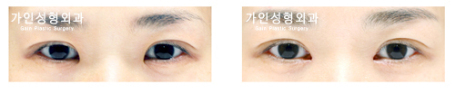앞트임