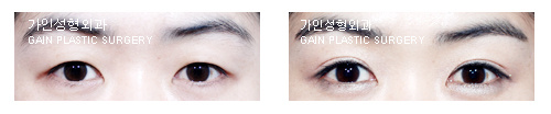 매몰법