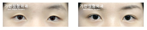 매몰법
