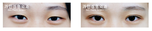 매몰법