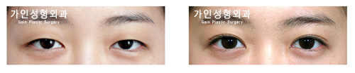 매몰법